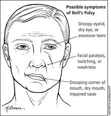 симптомы неврит лицевого нерва